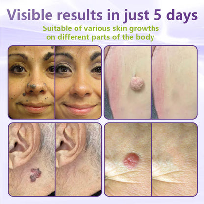 Maiakoo® Soluble Microneedle Botanical Skin Tag Removal Patch