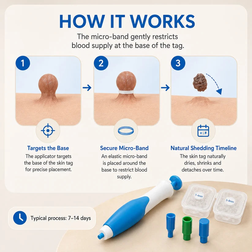 Skin Tag Removal Kit – 2-in-1 Auto Band Applicator with Dual Size Options for At-Home Use