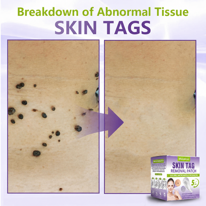 Maiakoo® Soluble Microneedle Botanical Skin Tag Removal Patch