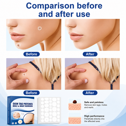 Maiakoo® Skin tag patches mole & wart remover