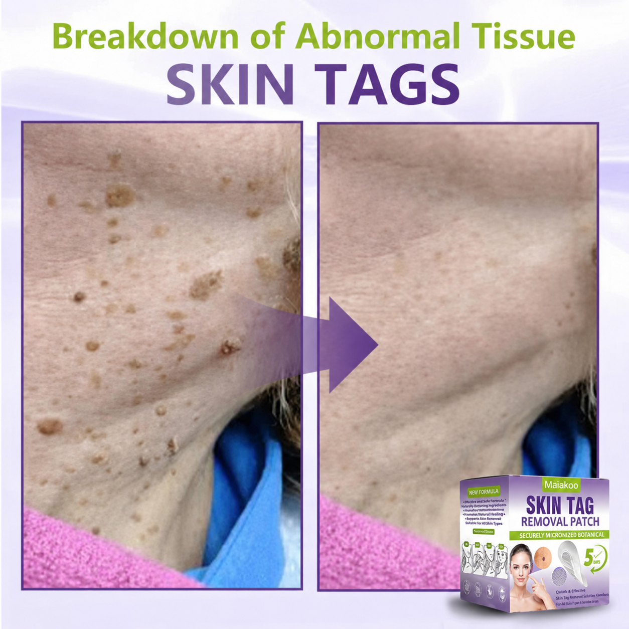 Maiakoo® Soluble Microneedle Botanical Skin Tag Removal Patch